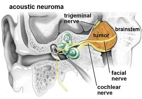 Acoustic Neuroma Symptoms, Treatment and Prognosis Patient