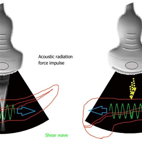 Acoustic Radiation Force Impulse