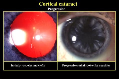 Acquired cataract pptx