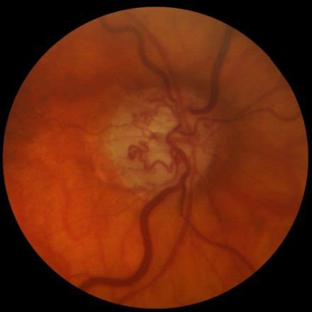 Acquired optociliary shunt vessels and their clinical