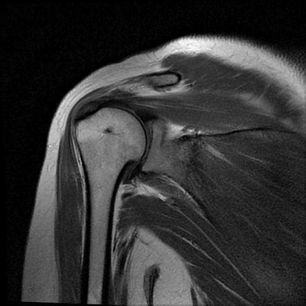 Acromion fracture Radiology Reference Article