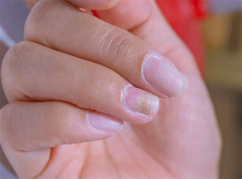 Based on a report, nearly 50% of people suffer from fingernail fungus as a result of using acrylic nails. In order to set the artificial nails over the original one, an adhesive is used that goes under your skin. The chances are even that moisture will be trapped in between the nails and thereby help the growth of fungal infection.. 