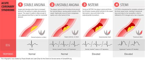 Acs vs mi.  Chronic Coronary Syndrome (CCS) Note: Stable Angina is NOT part ...