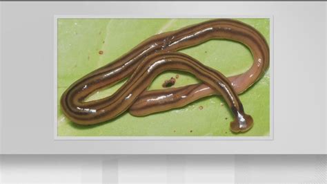 Active flatworm documented in teenager