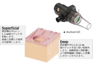 AcuPulse CO2レーザーでのほくろ・いぼ治療 ‣ 飯田橋ともじり …