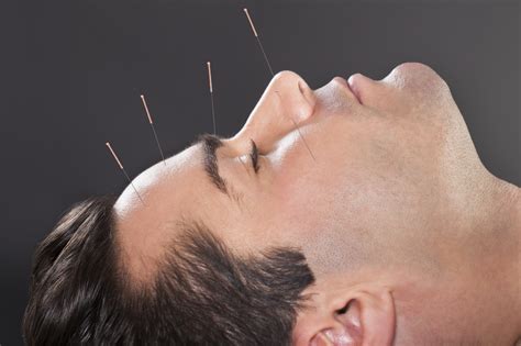 Acupuncture Alternative