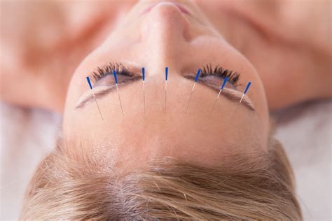 Acupuncture Analgesia in Migraine
