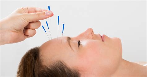 Acupuncture Treatment of Headache