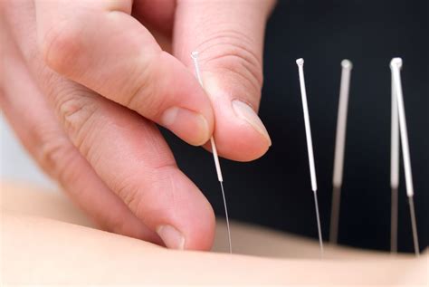 Acupuncture Treatment