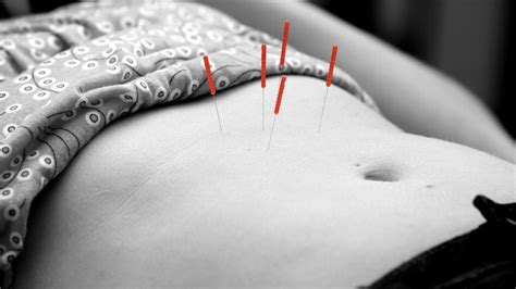 Acupuncture for GERD Research alternatives and FAQs