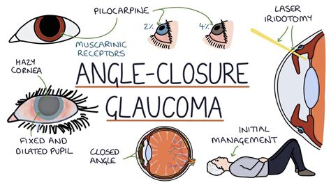 Acute Angle Closure Glaucoma in Emergency Medicine Background Pathophysiology Epidemiology