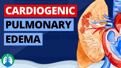Acute Cardiogenic Pulmonary Oedema