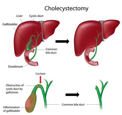 Acute Cholecystitis Cp2 Surgery by Helmy