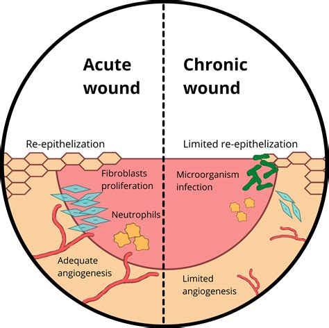 Acute Chronic Wound