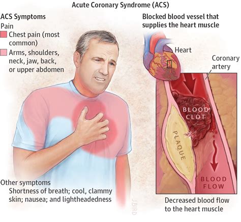 Acute Coronary Syndrome pdf