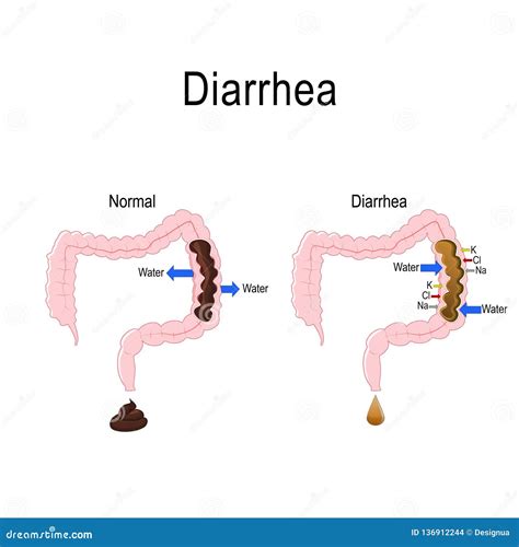 Acute Diarrhea 1