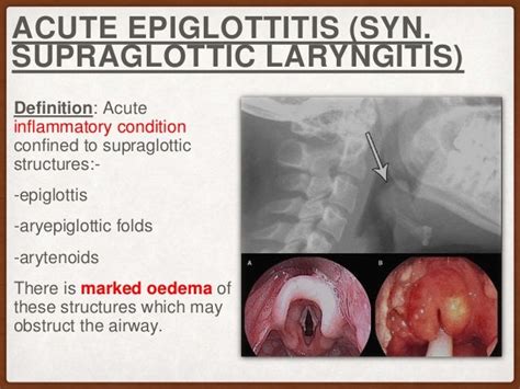 Acute Epiglottis