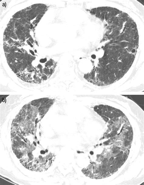 Acute Exacerbations of Idiopathic Pulmonary Fibrosis