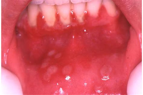 Acute Herpetic Gingivostomatitis Associated With Herpes Simplex Virus 2