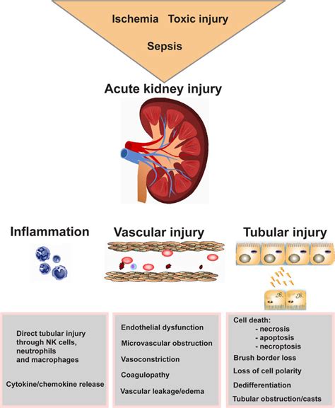 Acute Kidney Injury 3