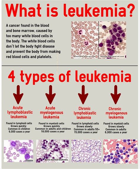 Acute Leukemia Treatment Information