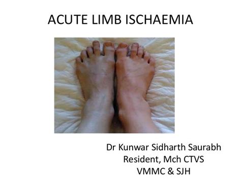 Acute Limb Ischemia Ashreen 1