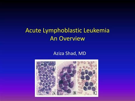 Acute Lymphoblastic Leukemia ppt