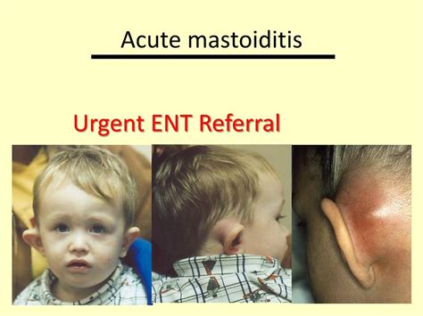 Acute Mastoiditis in Children