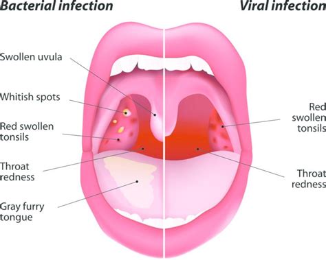 Acute Mouth Infections That Cause Fever, Sore Throat …