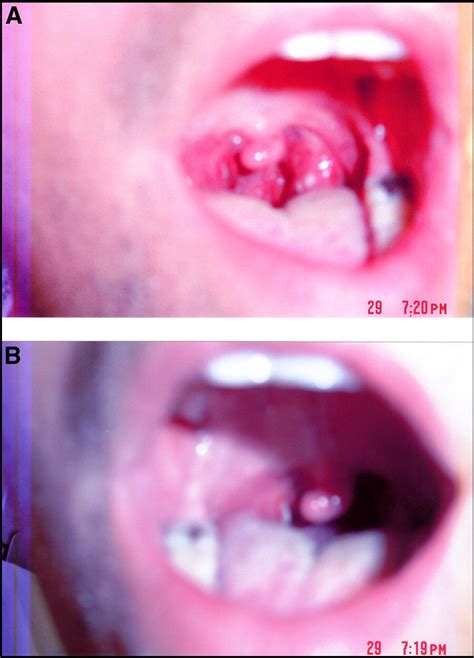 Acute Necrotizing Bacterial Tonsillitis With 13