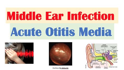 Acute Otitis Middle Ear