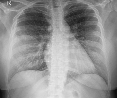 Acute Postoperative Negative Pressure Pulmonary 42