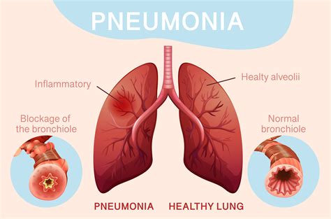 Acute Respiratory Infection and Pneumonia in India