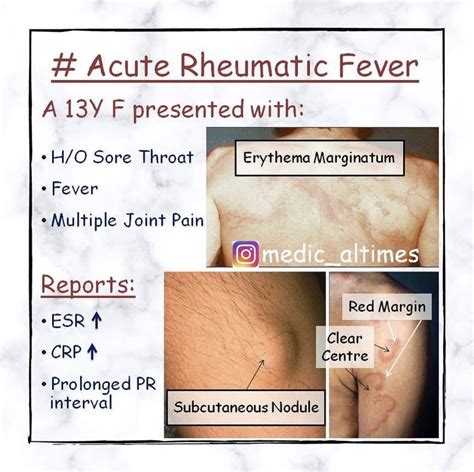Acute Rheumatic Fever 2006