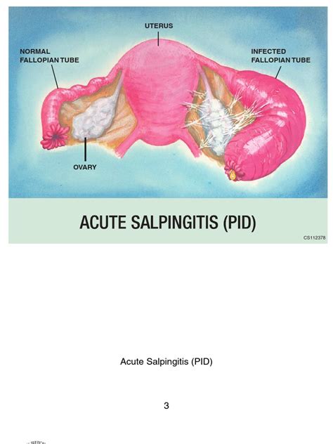 Acute Salpingitis PID