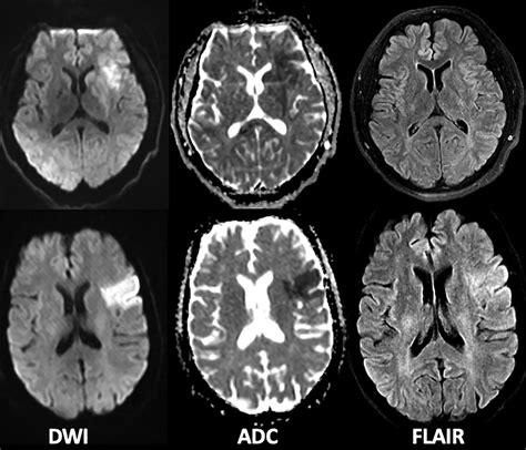 Acute Stroke Imaging What Clinicians Need to Know