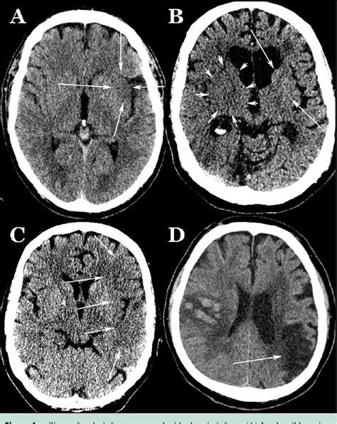 Acute Stroke Imaging What Clinicians Need to Know