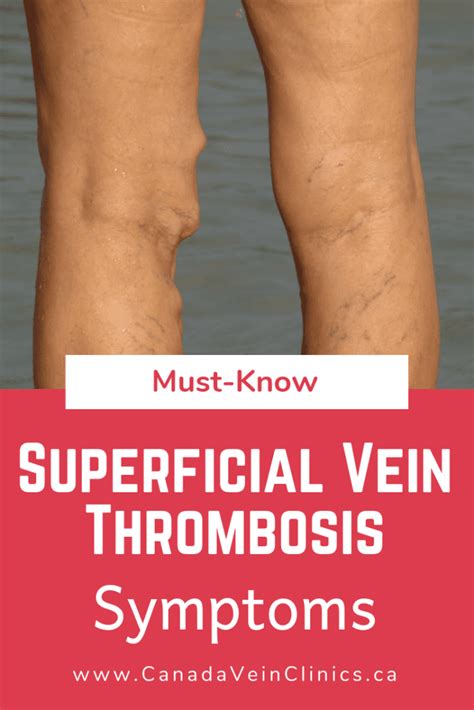 Acute Superficial Venous Thrombophlebitis