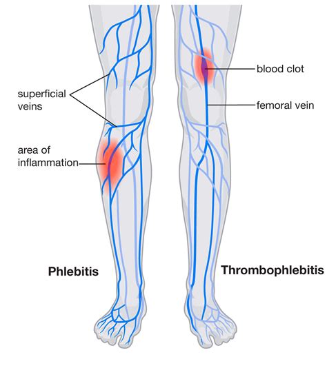 Acute Superficial Venous Thrombophlebitis