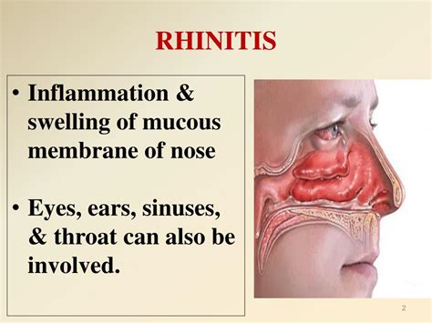 Acute Viral Rhinitis