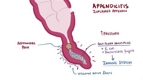 Acute appendicitis in the elderly 1 doc