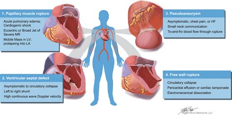 Acute coronary syndrome and arrhythmias pptx