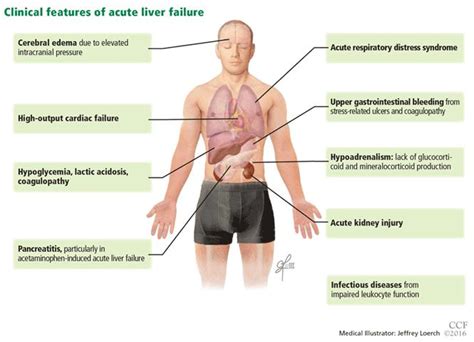 Acute liver failure - Symptoms, diagnosis and treatment - BMJ