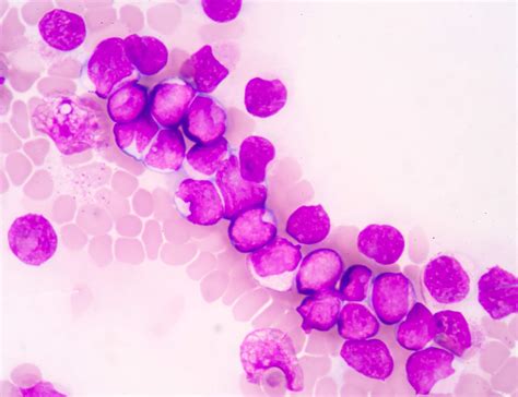 Acute myelogenous leukemia