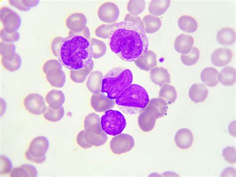 Acute myelogenous leukemia