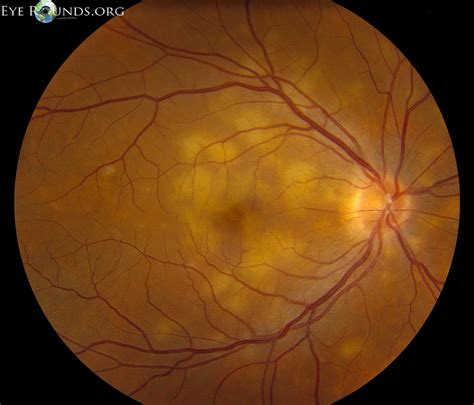 Acute posterior multifocal placoid pigment epitheliopathy …