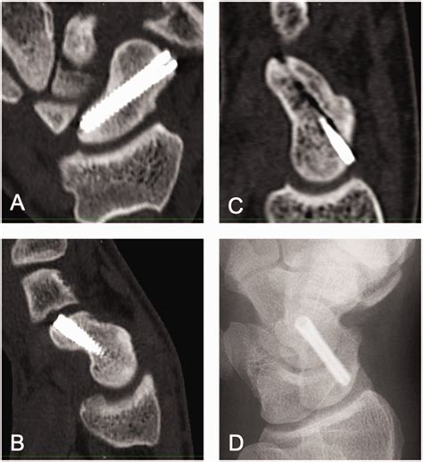 Acute scaphoid fractures: making decisions for treating a …