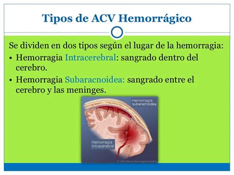 Acv Hemorragico Work
