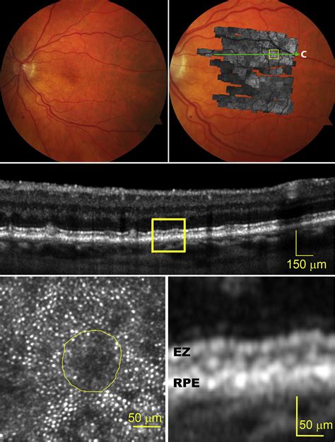 Adaptive optics scanning laser ophthalmoscope imaging: …