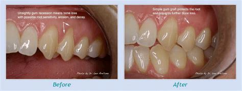 Among other assessments, periodontists look for plaque, inflammation, bleeding, and gum recession. The clinician uses a probe to measure the space between teeth and their surrounding gum tissue. Healthy gums fit a tooth snugly, with no more than one to three millimeters of space, known as pocket depth, between the tooth and surrounding gum tissue.. 